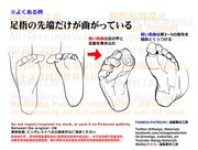 個人メモ：足指のよくある違和感